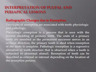 Understanding Radiographic Changes Due to Tooth Resorption