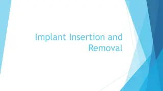 Guide to Implant Insertion and Removal