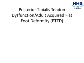 Posterior Tibialis Tendon Dysfunction (PTTD) in Adults