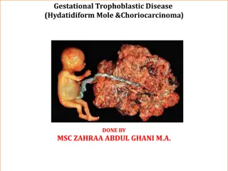 Gestational Trophoblastic Disease: Hydatidiform Mole & Choriocarcinoma