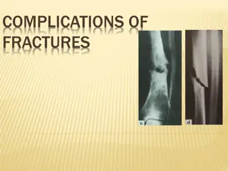 Complications of Fractures: Types and Consequences