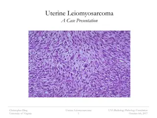 Understanding Uterine Leiomyosarcoma: A Case Presentation