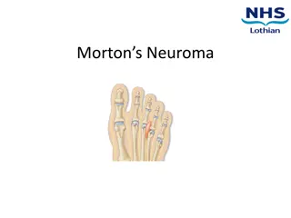 Understanding Morton's Neuroma: Causes, Symptoms, and Management