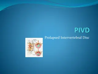 Prolapsed Intervertebral Disc (PIVD) and its Stages