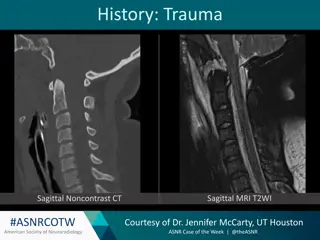 Atlanto-Occipital Dissociation: A Neuroradiology Case Study