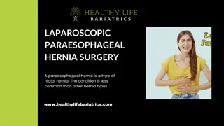 Laparoscopic Paraesophageal Hernia Surgery in Los Angeles CA