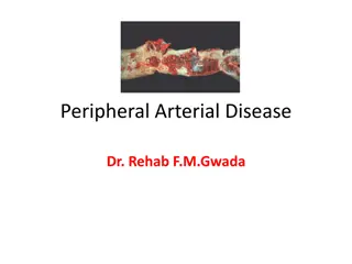 Peripheral Arterial Disease (PAD) - Overview and Management