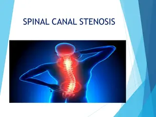 Spinal Canal Stenosis: Causes, Symptoms, and Classification