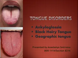 Tongue Disorders: Ankyloglossia, Black Hairy Tongue, Geographic Tongue