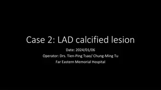 Case Study: Successful Treatment of LAD Calcified Lesion with Percutaneous Coronary Intervention