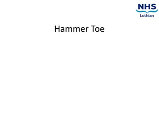 Hammer Toe: Causes, Symptoms, Diagnosis, and Management