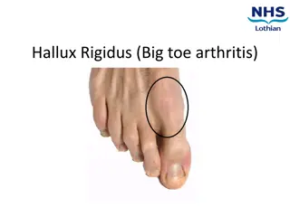 Hallux Rigidus: Causes, Symptoms, Diagnosis, and Management