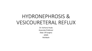 Hydronephrosis and Vesicoureteral Reflux - A Comprehensive Guide