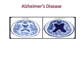 Alzheimer's Disease: Causes, Symptoms & Impact