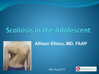 Adolescent Idiopathic Scoliosis: Screening, Signs, and Management