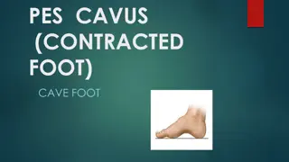 Understanding Pes Cavus: Causes, Symptoms, and Treatment Options