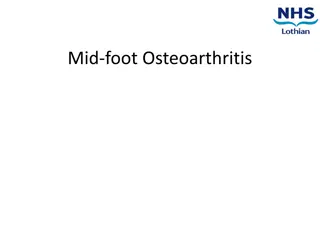 Understanding Midfoot Osteoarthritis: Causes, Symptoms, and Management