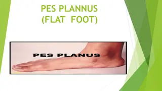 Pes Planus (Flat Foot) and its Management