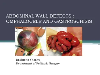 Abdominal Wall Defects: Omphalocele and Gastroschisis Overview