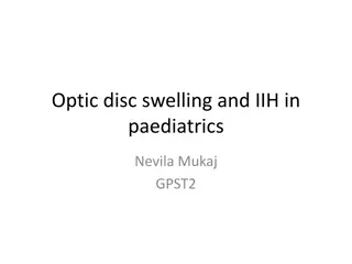 Optic Disc Swelling and IIH in Paediatrics: A Case Study of Papilloedema in a 12-year-old Female