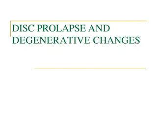 Understanding Disc Prolapse and Degenerative Changes in the Spine