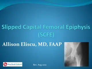 Understanding SCFE (Slipped Capital Femoral Epiphysis) in Adolescents