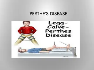 Understanding Perthes Disease in Pediatric Patients