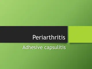 Periarthritis Adhesive Capsulitis: Overview, Symptoms, and Stages