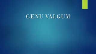 Genu Valgum: Causes, Symptoms, Diagnosis, and Treatment