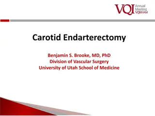 Carotid Endarterectomy Review and Case Discussion