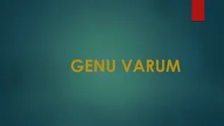 Genu Varum (Bow Leg Deformity) and Its Management