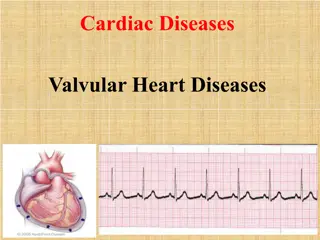 Mitral Stenosis: Causes, Symptoms, and Pathophysiology