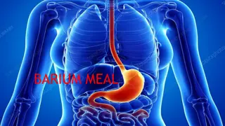 Barium Meal Radiological Study