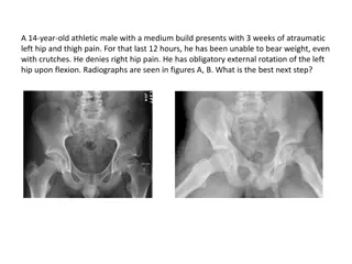 Slipped Capital Femoral Epiphysis: Adolescent Hip Disorder