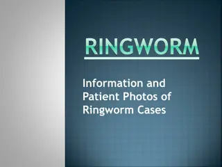 Understanding Ringworm: Causes, Types, and Treatment