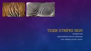 Tiger Stripes Sign in Cardiology