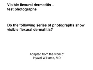 Assessment of Visible Flexural Dermatitis Through Test Photographs