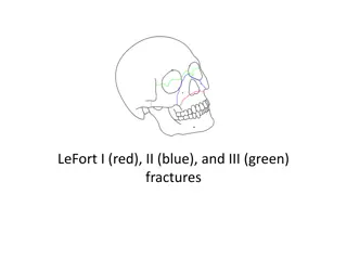 LeFort I (red), II (blue), and III (green)  fractures