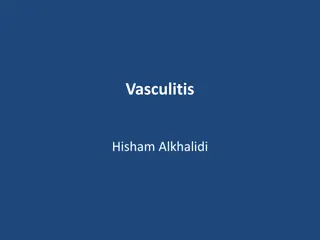 Vasculitis