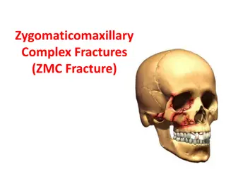 Zygomaticomaxillary Complex Fractures